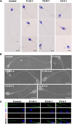 Novel homozygous variants in TTC12 cause male infertility with asthenoteratozoospermia owing to dynein arm complex and mitochondrial sheath defects in flagella